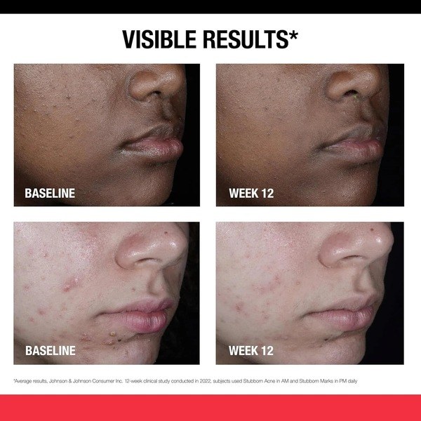 Neutrogena Neutrogena Retinol SA, Stubborn Marks PM Treatment - Angle View - for Sale in Kenya