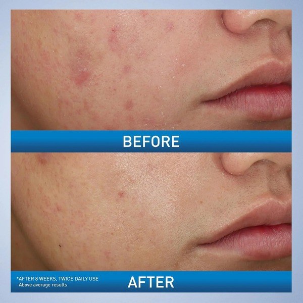 CeraVe CeraVe Acne Foaming Cream Wash 10% Benzoyl Peroxide - Ingredients View - for Sale in Kenya