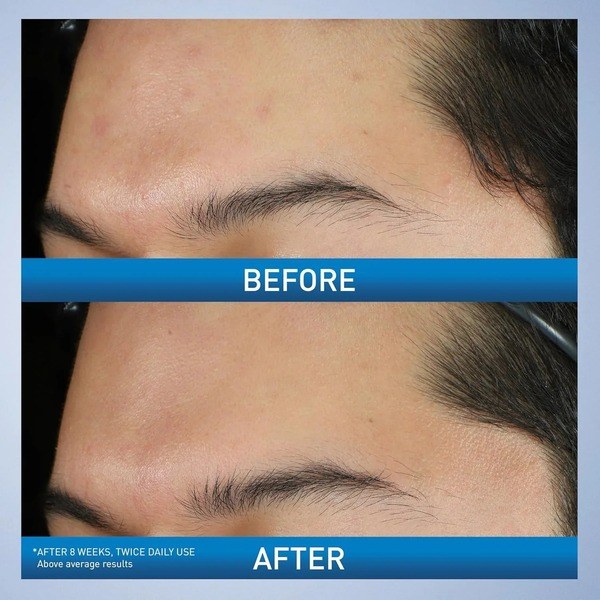 CeraVe CeraVe Acne Foaming Cream Wash 10% Benzoyl Peroxide - Angle View - for Sale in Kenya