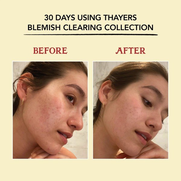Thayers Thayers Blemish Clearing Lemongrass Face Toner with Salicylic Acid - Ingredients View - for Sale in Kenya