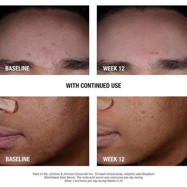 Neutrogena Neutrogena Stubborn Blackheads - Angle View - for Sale in Kenya