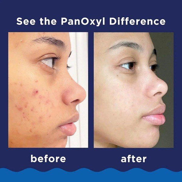 PanOxyl PanOxyl Acne Foaming Wash 156 g - Ingredients View - for Sale in Kenya