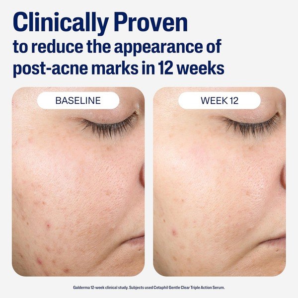 Cetaphil CETAPHIL Post-Acne Serum, Retinol Alternative - Back View - for Sale in Kenya