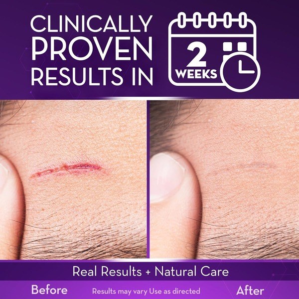 cicatricure Cicatricure Advanced Scar Gel - Angle View - for Sale in Kenya